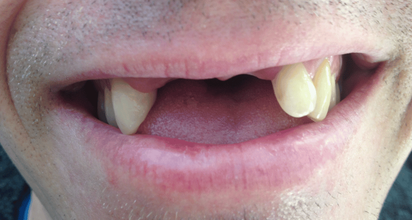 Before - Rothwell Dental