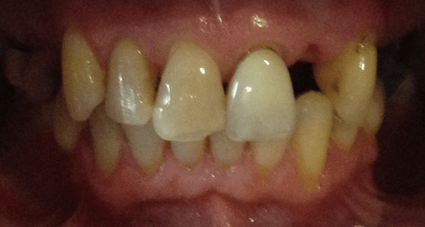 Before - Rothwell Dental