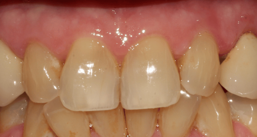 Before - Rothwell Dental