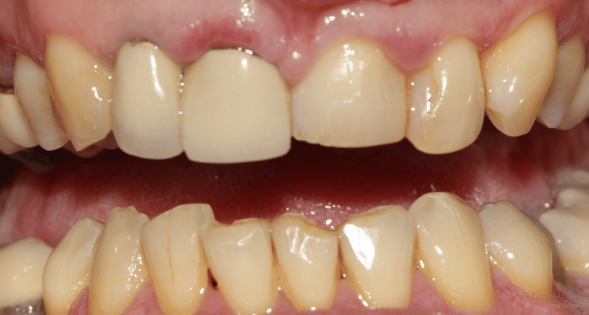 Before - Rothwell Dental