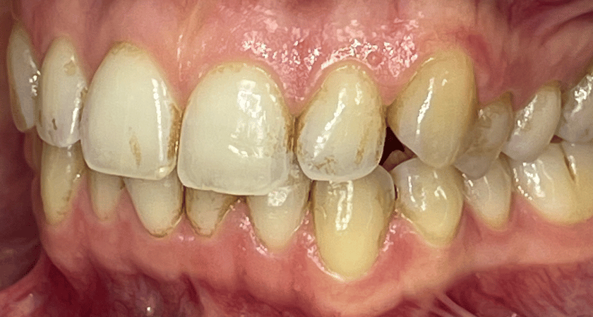 Before - Rothwell Dental